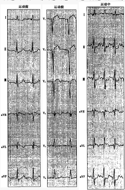 为何心律失常“盯”上中青年人(图1)